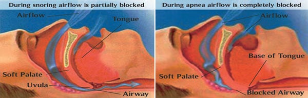 Sleep-Apnea
