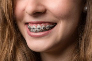 Invisalign Orthodontist in Greenwood