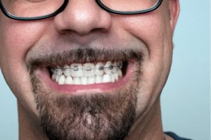 Clear Braces and Invisalign in Missouri