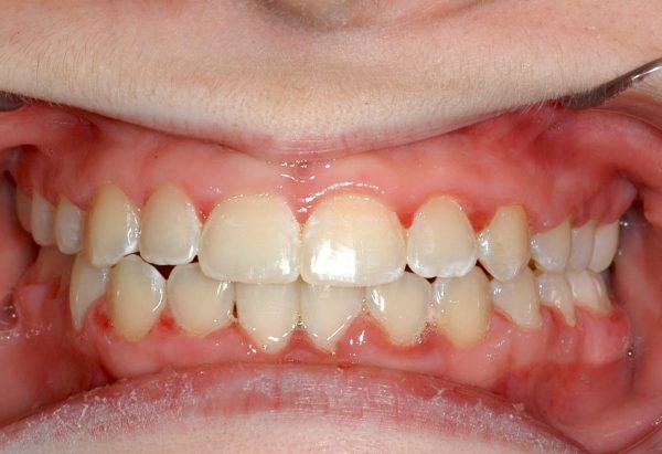 After Picture Lakewood Orthodontics Lee's Summit Pleasant Hill MO