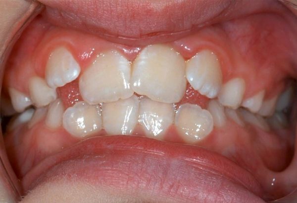 Before Picture Lakewood Orthodontics Lee's Summit Pleasant Hill MO