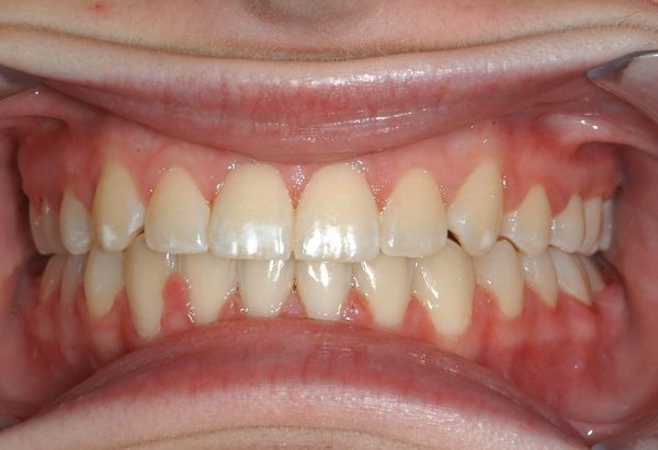 After Picture Lakewood Orthodontics Lee's Summit Pleasant Hill MO