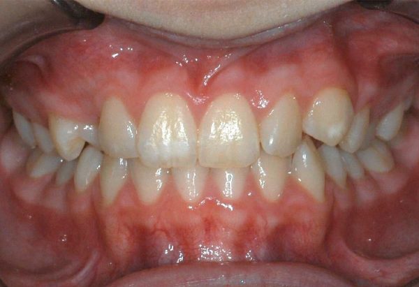Initial Picture Lakewood Orthodontics Lee's Summit Pleasant Hill MO