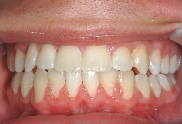 After Image Lakewood Orthodontics Lee's Summit Pleasant Hill MO