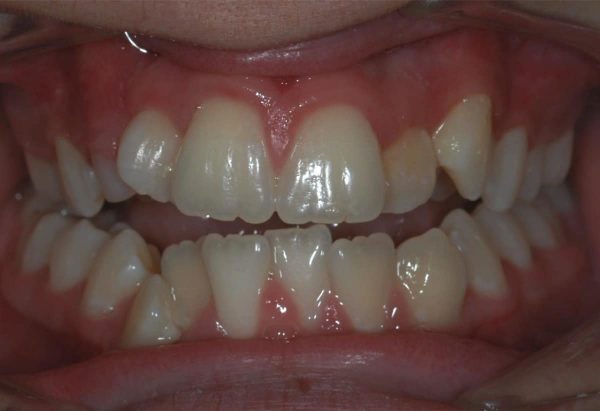 Before Image Lakewood Orthodontics Lee's Summit Pleasant Hill MO