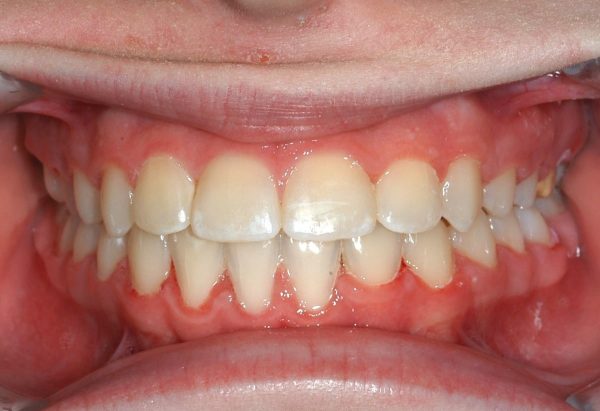 After Picture Lakewood Orthodontics Lee's Summit Pleasant Hill MO
