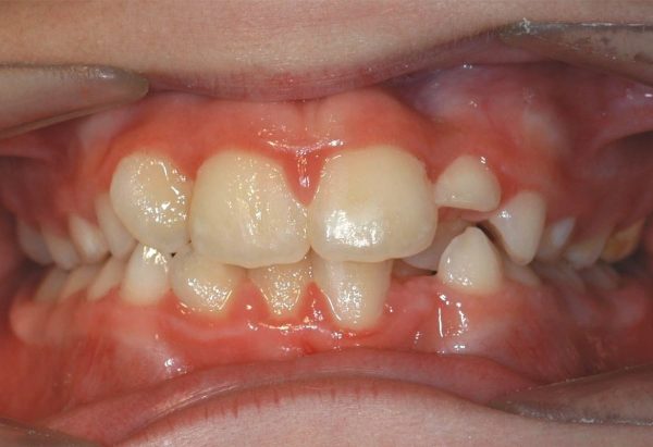 Before Picture Lakewood Orthodontics Lee's Summit Pleasant Hill MO