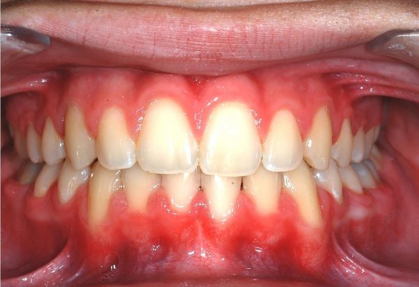 After Image Lakewood Orthodontics Lee's Summit Pleasant Hill MO