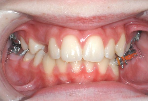 Before Image Lakewood Orthodontics Lee's Summit Pleasant Hill MO