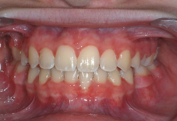After Picture Lakewood Orthodontics Lee's Summit Pleasant Hill MO