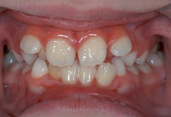 Before Picture Lakewood Orthodontics Lee's Summit Pleasant Hill MO