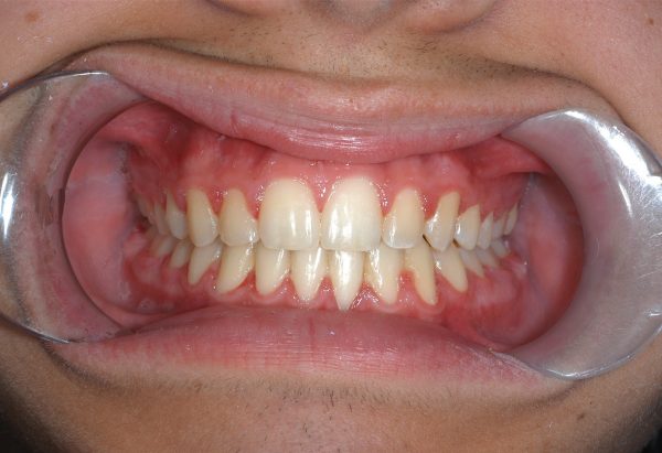 After Image Lakewood Orthodontics Lee's Summit Pleasant Hill MO