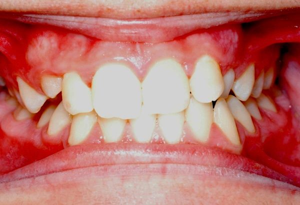 Before Image Lakewood Orthodontics Lee's Summit Pleasant Hill MO