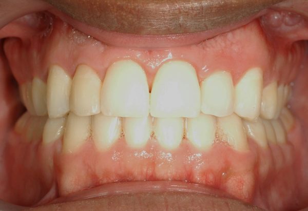 Final Image Lakewood Orthodontics Lee's Summit Pleasant Hill MO